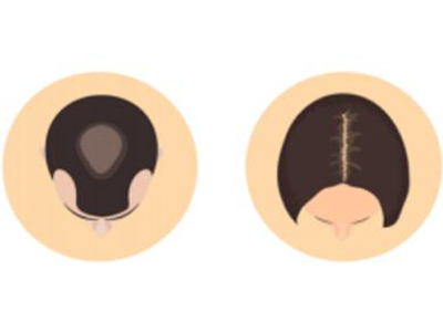 Slight thinning. Damaged hair. Dry, flaky scalp.