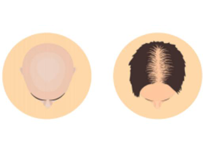 Partial to full baldness.