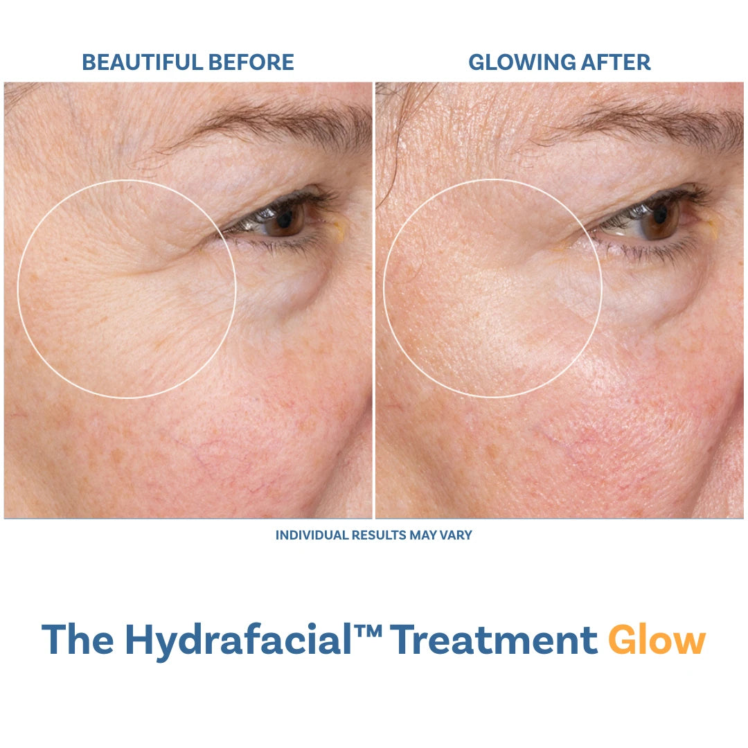 The Hydrafacial™ Treatment Glow