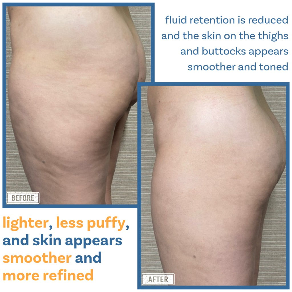 Visible smoothing after one session